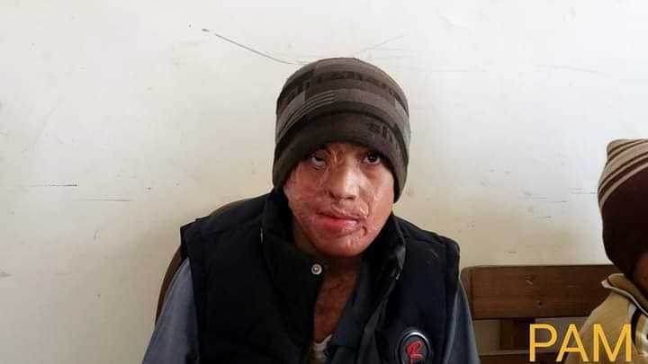 دوکتوران دهکده صلح المان برای تشخیص و معالجه اطفال مبتلا به بیماری استخوان شکن و سوختگی شدید به کابل رسید